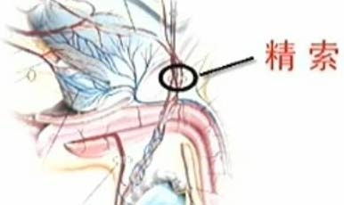 精索静脉曲张